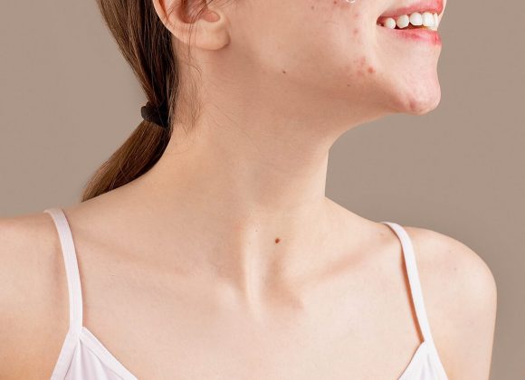Acne: What’s The Missing Link?