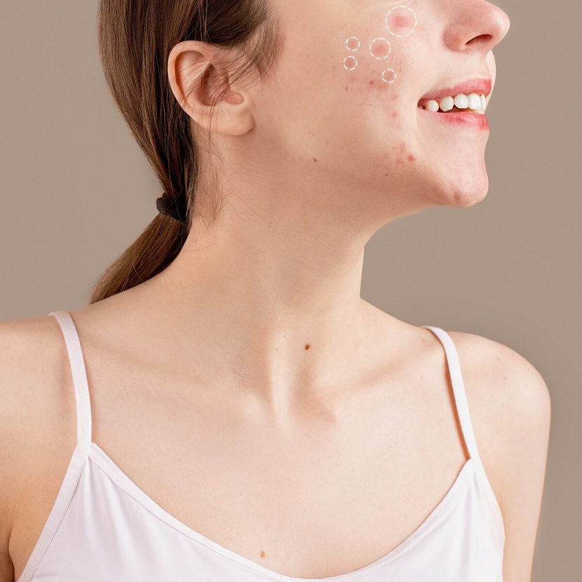 Acne: What’s The Missing Link? Acne: What’s The Missing Link?
