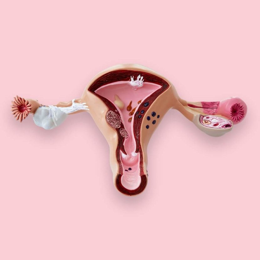 PCOS and Nutrition: All You Need To Know PCOS and Nutrition_ All You Need To Know - 1